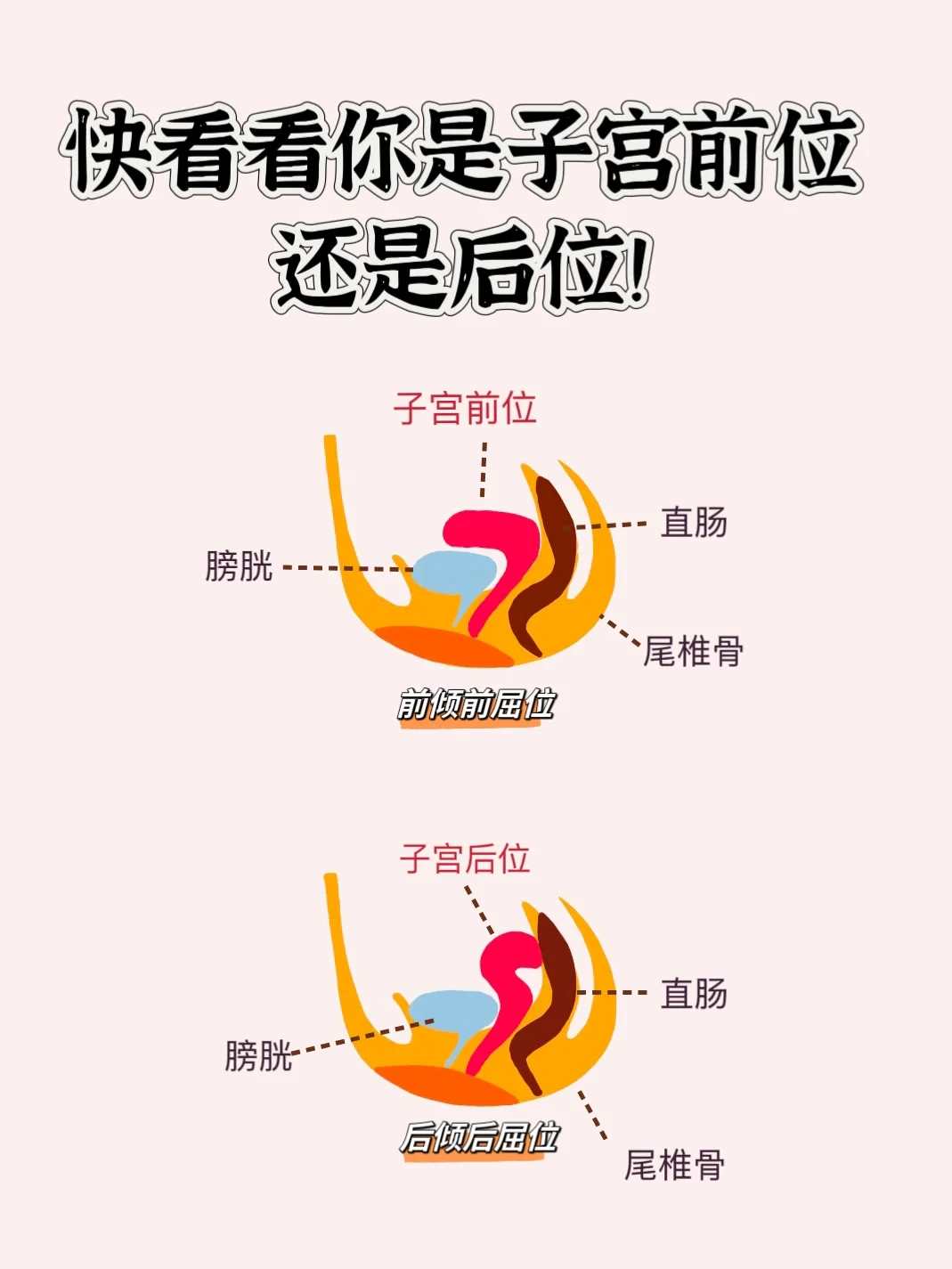 子宫位置影响备孕，快看看你是哪一种？,三代试管代生助孕宝宝，试管代孕有搞错